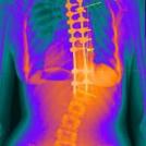 Scoliosis X-ray