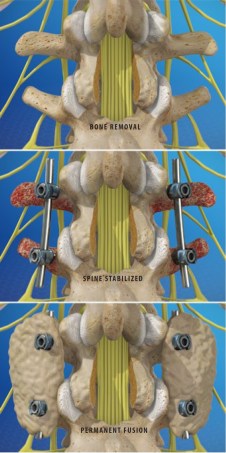 Spinal Fusion Brochure Images_Spine-health